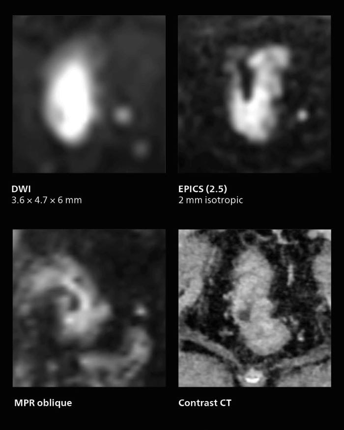 MRI of rectal cancer: fast isotropic 3D acquisitions providing excellent image quality with use of AI-enabled SmartSpeed, mobile two