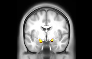 MultiBand SENSE fMRI faces vs places subcort coronal