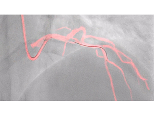 dynamic coronary