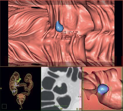 ct-virtual-colonoscopy